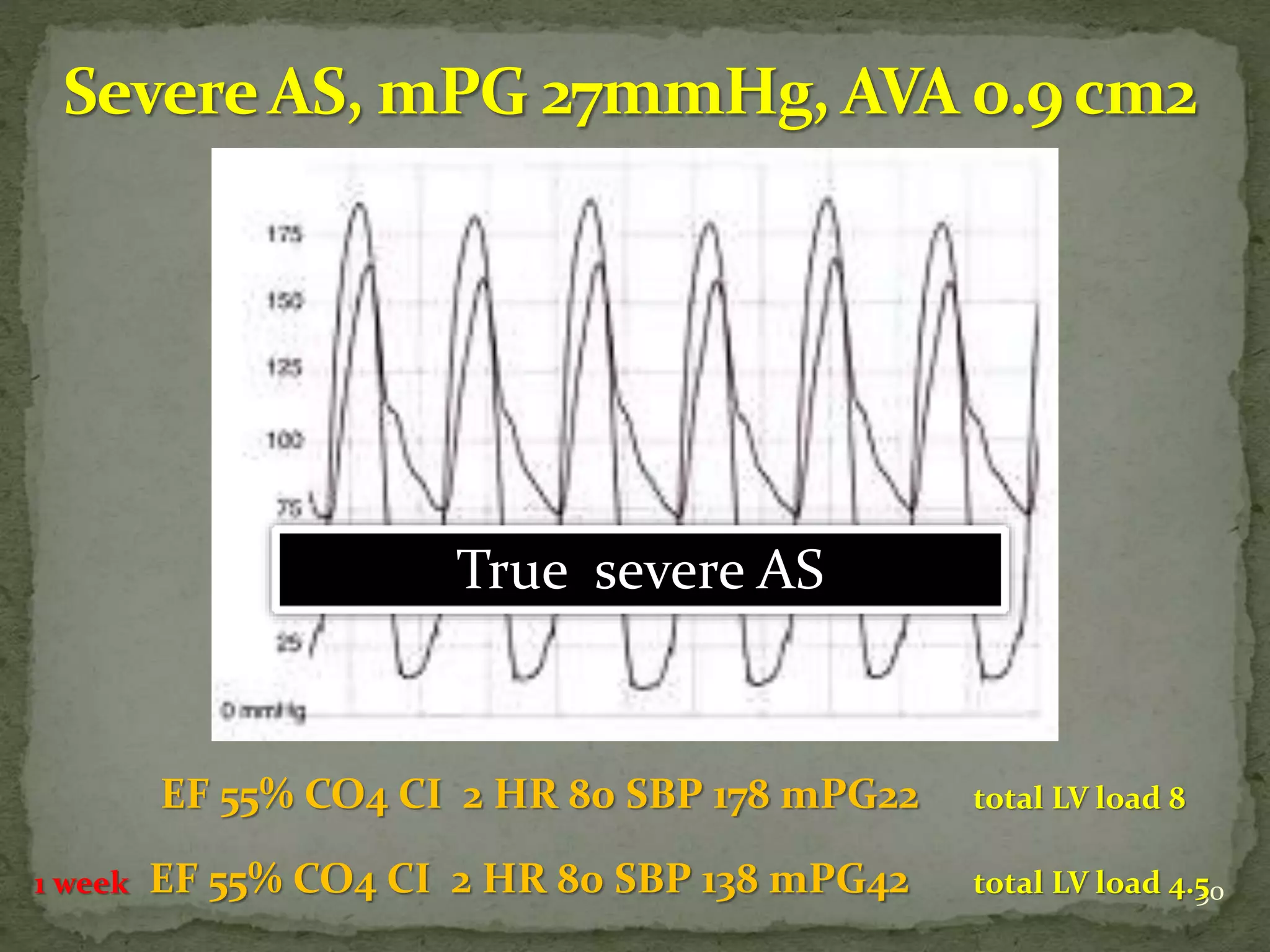 30
EF 55% CO4 CI 2 HR 80 SBP 178 mPG22
EF 55% CO4 CI 2 HR 80 SBP 138 mPG42
total LV load 8
total LV load 4.51 week
True severe AS
 