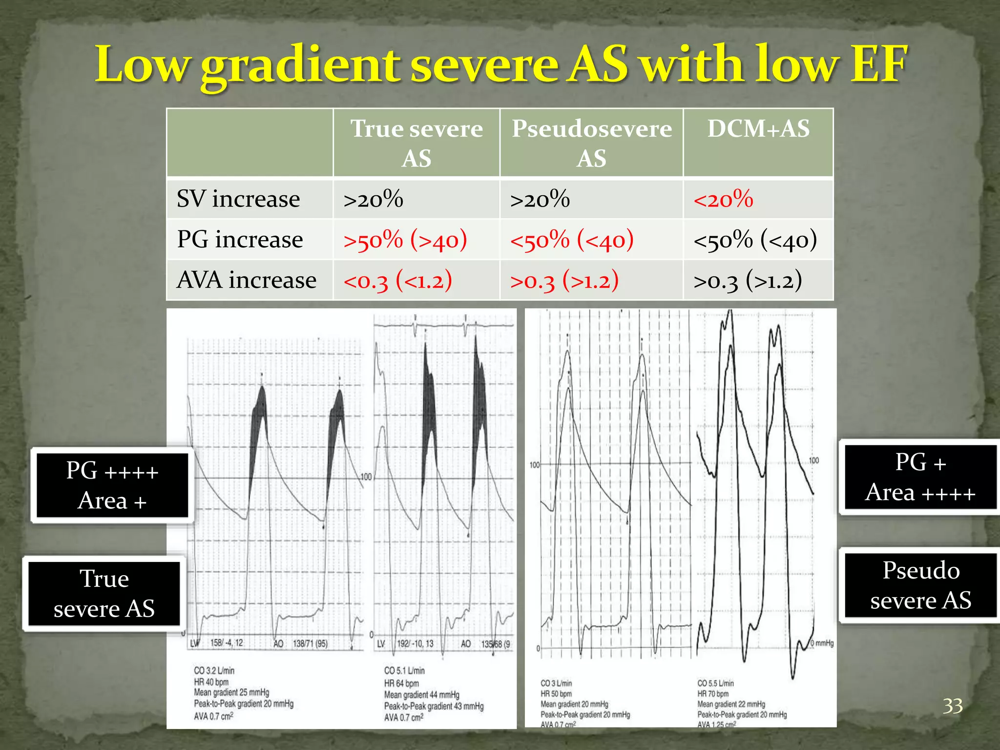 33
True severe
AS
Pseudosevere
AS
DCM+AS
SV increase >20% >20% <20%
PG increase >50% (>40) <50% (<40) <50% (<40)
AVA increase <0.3 (<1.2) >0.3 (>1.2) >0.3 (>1.2)
PG ++++
Area +
PG +
Area ++++
True
severe AS
Pseudo
severe AS
 