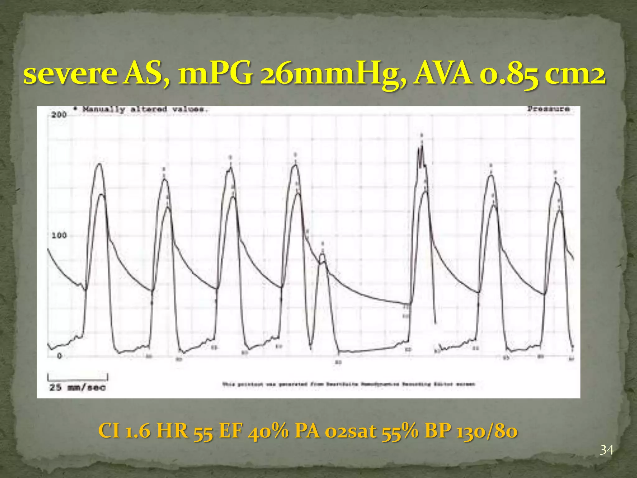 34
CI 1.6 HR 55 EF 40% PA o2sat 55% BP 130/80
 