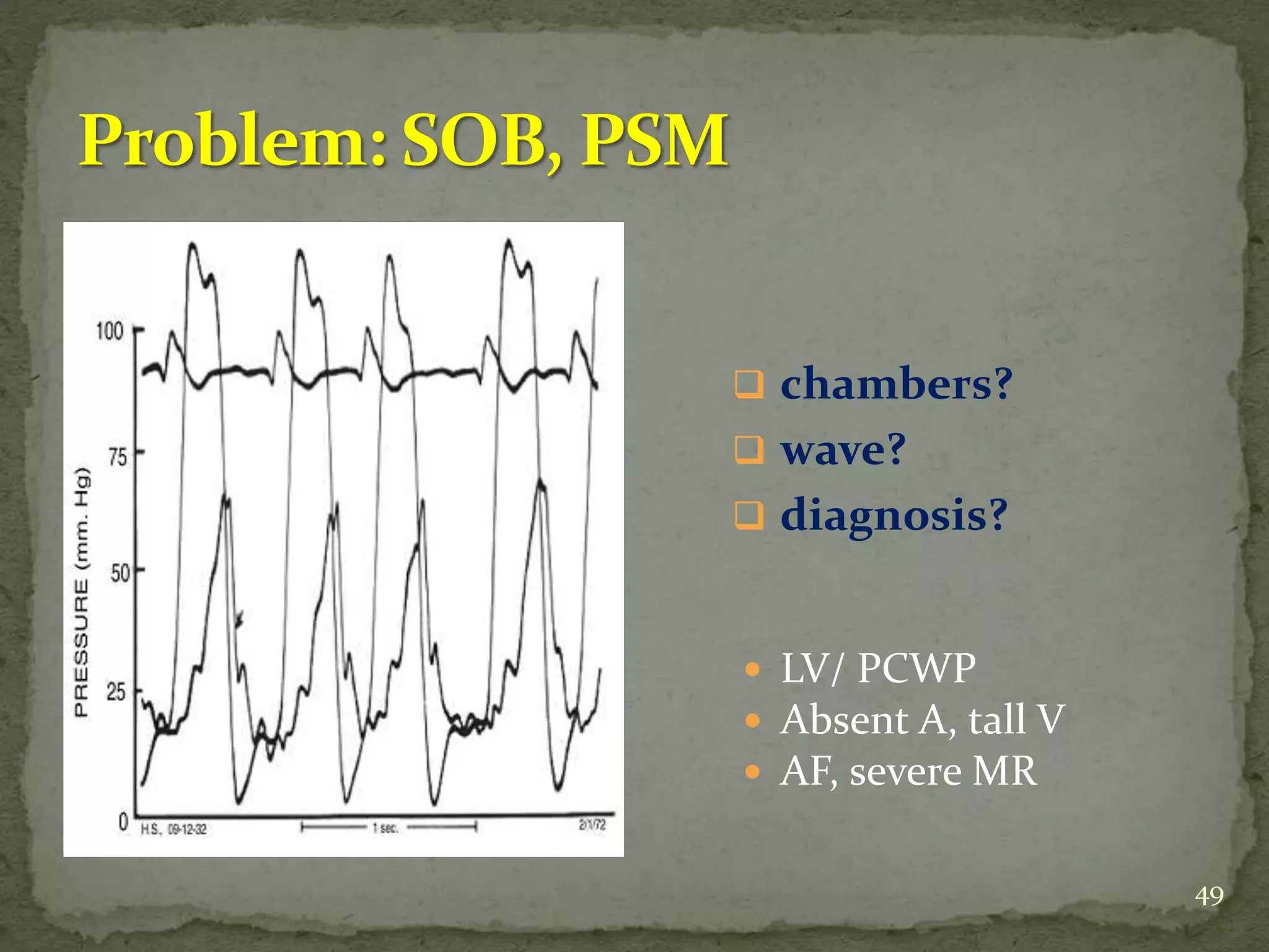  chambers?
 wave?
 diagnosis?
49
 LV/ PCWP
 Absent A, tall V
 AF, severe MR
 