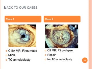 PROSTHETIC HEART VALVES | PPTX