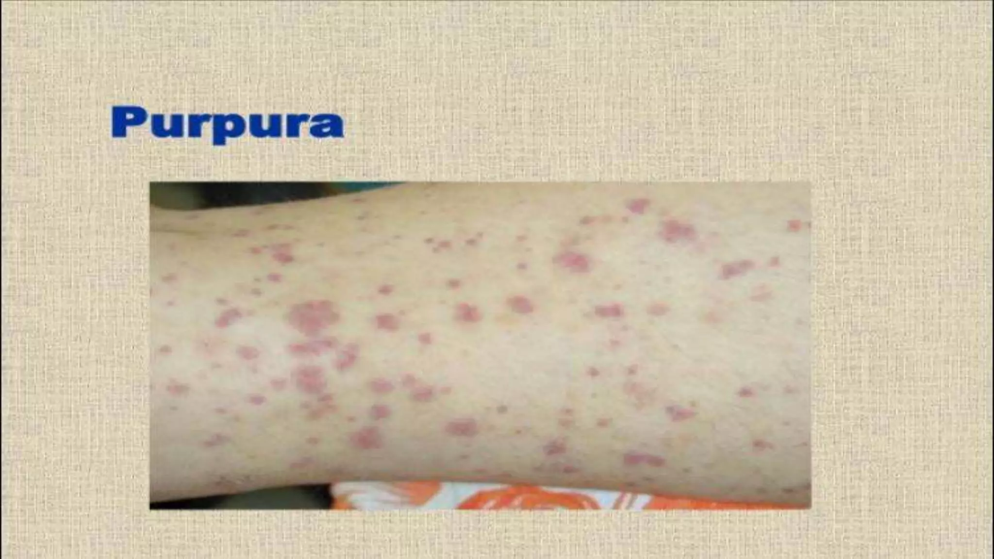 Dic- disseminated intravascular coagulation | PPTX