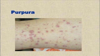 Dic- disseminated intravascular coagulation | PPTX