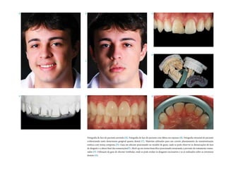 A

B

C

D
E

E

F

G

Fotografia de face do paciente sorrindo (A). Fotografia de face do paciente com lábios em repouso (B). Fotografia intraoral do paciente
evidenciando tanto desarmonia gengival quanto dental (C). Materiais utilizados para um correto planejamento da reanatomização
estética com resina composta (D). Guia em silicone posicionado no modelo de gesso, onde se pode observar as demarcações de área
de desgaste e a altura final das restaurações(E). Mock-up em resina bisacrílica posicionado mostrando a previsão do tratamento restaurador (F). Utilização da guia de silicone vestibular, onde se pode avaliar os desgastes necessários e os já realizados sobre as estruturas
dentais (G).

 
