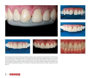 H

I

J

K

L

Posicionamento da guia de silicone palatina, para facilitar a inserção da resina composta para a reanatomização (H). Aspecto branco
opaco dos dentes após o condicionamento ácido (I). Confecção das camadas de resina opaca simulando a dentina, já com a confecção
dos mamelos dentinários (J). Aplicação de uma resina translúcida clara como última camada simulando o esmalte superficial na superfície vestibular dos dentes tratados (K). Aspecto imediato do sorriso, sem a etapa de acabamento e polimento, já evidenciando uma
nítida melhora na naturalidade de formato e cor dos dentes (L). Demarcação intraoral das áreas de reflexão e dispersão de luz com
lápis (M).

18
19

v.1, n.3, 2012

M

 
