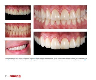 Q

N

O

R

P

Dentes anterossuperiores após o protocolo de acabamento e polimento (N). Aspecto intraoral do tratamento finalizado. Note que o sorriso apresenta naturalidade e harmonia com os tecidos moles do paciente (O). Sorriso do paciente com a finalização do tratamento (P). Fotografias do sucesso clínico do tratamento restaurador com compósito nos dentes anteriores após 1 ano de acompanhamento (Q-R).

20
21

v.1, n.3, 2012

 