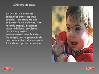 Síndrome de Down:


Es uno de los defectos
congénitos genéticos más
comunes. Se trata de una
combinación de defectos, con
retardo mental, facciones
características, problemas
cardiacos y otros
inconvenientes para la salud.
Se origina por la presencia de
una copia extra del cromosoma
21 o de una parte del mismo
 