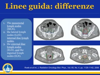 Linee guida: differenze
1. The mesorectal
lymph nodes
(MLN),
2. the lateral lymph
nodes (LLN):
internal iliac lymph
nodes,
3. the external iliac
lymph nodes
(ELN), and the
inguinal lymph
nodes (ILN).

Roels et al Int. J. Radiation Oncology Biol. Phys., Vol. 65, No. 4, pp. 1129–1142, 2006

 