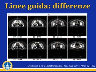 Linee guida: differenze

Myerson et al Int J Radiat Oncol Biol Phys. 2009 July 1; 74(3): 824–830

 