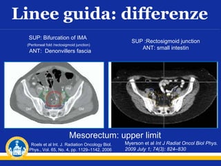 Linee guida: differenze
SUP: Bifurcation of IMA
(Peritoneal fold /rectosigmoid junction)

ANT: Denonvillers fascia

SUP :Rectosigmoid junction
ANT: small intestin

Mesorectum: upper limit
Roels et al Int. J. Radiation Oncology Biol.
Phys., Vol. 65, No. 4, pp. 1129–1142, 2006

Myerson et al Int J Radiat Oncol Biol Phys.
2009 July 1; 74(3): 824–830

 