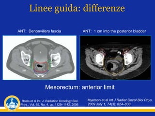 Linee guida: differenze
ANT: Denonvillers fascia

ANT: 1 cm into the posterior bladder

Mesorectum: anterior limit
Roels et al Int. J. Radiation Oncology Biol.
Phys., Vol. 65, No. 4, pp. 1129–1142, 2006

Myerson et al Int J Radiat Oncol Biol Phys.
2009 July 1; 74(3): 824–830

 