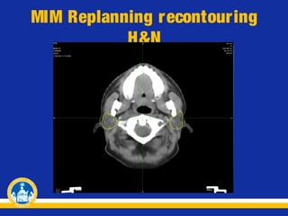 MIM Replanning r econtouring
H&N

 