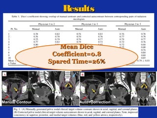 Results

Mean Dice
Coefficient=0.8
Spared Time=26%

Manual Contour

Auto+Correction

 