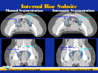 Internal Iliac Subsite

Manual Segmentation
Master contour

Automatic Segmentation
Autosegmentation contour

Manual contour

Master contour

Master contour

Manual contour

Autosegmentation
contour

Median Dice coefficient= 0,645

Median Dice coefficient= 0,590

Master contour

 
