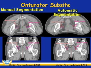Onturator Subsite

Manual Segmentation
Manual contour
Master contour

Manual contour

Master contour

Median Dice coefficient= 0,550

Automatic
Segmentation

Automatic contour

Automatic contour

Master contour

Master contour

Median Dice coefficient= 0,525

 