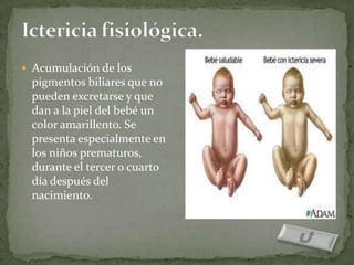  Acumulación de los
 pigmentos biliares que no
 pueden excretarse y que
 dan a la piel del bebé un
 color amarillento. Se
 presenta especialmente en
 los niños prematuros,
 durante el tercer o cuarto
 día después del
 nacimiento.
 