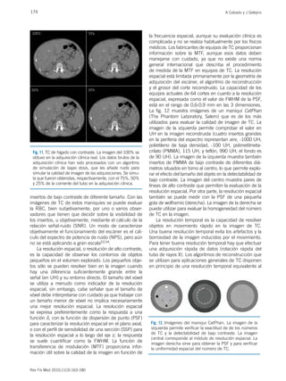 174 A Calzado y J Geleijns
Rev Fis Med 2010;11(3):163-180
insertos de bajo contraste de diferente tamaño. Con las
imágenes de TC de estos maniquíes se puede evaluar
la RBC, bien subjetivamente, por uno o varios obser-
vadores que tienen que decidir sobre la visibilidad de
los insertos, u objetivamente, mediante el cálculo de la
relación señal-ruido (SNR). Un modo de caracterizar
objetivamente el funcionamiento del escáner es el cál-
culo del espectro de potencia de ruido (NPS), pero aún
no se está aplicando a gran escala53,54.
La resolución espacial, o resolución de alto contraste,
es la capacidad de observar los contornos de objetos
pequeños en el volumen explorado. Los pequeños obje-
tos sólo se pueden resolver bien en la imagen cuando
hay una diferencia suficientemente grande entre la
señal (en UH) y su entorno directo. El tamaño del vóxel
se utiliza a menudo como indicador de la resolución
espacial, sin embargo, cabe señalar que el tamaño de
vóxel debe interpretarse con cuidado ya que trabajar con
un tamaño menor de vóxel no implica necesariamente
una mejor resolución espacial. La resolución espacial
se expresa preferentemente como la respuesta a una
función d, con la función de dispersión de punto (PSF)
para caracterizar la resolución espacial en el plano axial,
o con el perfil de sensibilidad de una sección (SSP) para
la resolución espacial a lo largo del eje z; la respuesta
se suele cuantificar como la FWHM. La función de
transferencia de modulación (MTF) proporciona infor-
mación útil sobre la calidad de la imagen en función de
la frecuencia espacial, aunque su evaluación clínica es
complicada y no se realiza habitualmente por los físicos
médicos. Los fabricantes de equipos de TC proporcionan
información sobre la MTF, aunque esos datos deben
manejarse con cuidado, ya que no existe una norma
general internacional que describa el procedimiento
de medida de la MTF en equipos de TC. La resolución
espacial está limitada primariamente por la geometría de
adquisición del escáner, el algoritmo de reconstrucción
y el grosor del corte reconstruido. La capacidad de los
equipos actuales de 64 cortes en cuanto a la resolución
espacial, expresada como el valor de FWHM de la PSF,
está en el rango de 0,6-0,9 mm en las 3 dimensiones.
La fig. 12 muestra imágenes de un maniquí CatPhan
(The Phantom Laboratory, Salem) que es de los más
utilizados para evaluar la calidad de imagen de TC. La
imagen de la izquierda permite comprobar el valor en
UH en la imagen reconstruida (cuatro insertos grandes
en la periferia del espectro representan aire, -1000 UH;
polietileno de baja densidad, -100 UH, polimetilmeta-
crilato (PMMA), 115 UH, y teflón, 990 UH; el fondo es
de 90 UH). La imagen de la izquierda muestra también
insertos de PMMA de bajo contraste de diferentes diá-
metros situados en torno al centro, lo que permite explo-
rar el efecto del tamaño del objeto en la detectabilidad de
bajo contraste. La imagen del centro muestra pares de
líneas de alto contraste que permiten la evaluación de la
resolución espacial. Por otra parte, la resolución espacial
también se puede medir con la PSF de una pequeña
gota de wolframio (derecha). La imagen de la derecha se
puede utilizar para evaluar la homogeneidad del número
de TC en la imagen.
La resolución temporal es la capacidad de resolver
objetos en movimiento rápido en la imagen de TC.
Una buena resolución temporal evita los artefactos y la
borrosidad de la imagen inducidos por el movimiento.
Para tener buena resolución temporal hay que efectuar
una adquisición rápida de datos (rotación rápida del
tubo de rayos X). Los algoritmos de reconstrucción que
se utilizan para aplicaciones generales de TC disponen
en principio de una resolución temporal equivalente al
Fig. 12. Imágenes del maniquí CatPhan. La imagen de la
izquierda permite verificar la exactitud de de los números
de TC y la detectabilidad de bajo contraste. La imagen
central corresponde al módulo de resolución espacial. La
imagen derecha sirve para obtener la PSF y para verificar
la uniformidad espacial del número de TC.
100% 75%
50% 25%
Fig. 11. TC de hígado con contraste. La imagen del 100% se
obtuvo en la adquisición clínica real. Los datos brutos de la
adquisición clínica han sido procesados con un algoritmo
de simulación de bajas dosis, que les añade ruido para
simular la calidad de imagen de las adquisiciones. Se simu-
la que fueron obtenidas, respectivamente, con el 75%, 50%
y 25% de la corriente del tubo en la adquisición clínica.
 