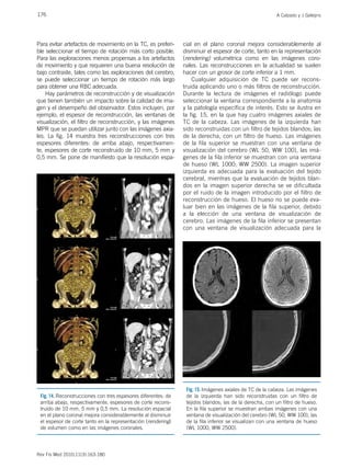 176 A Calzado y J Geleijns
Rev Fis Med 2010;11(3):163-180
Para evitar artefactos de movimiento en la TC, es preferi-
ble seleccionar el tiempo de rotación más corto posible.
Para las exploraciones menos propensas a los artefactos
de movimiento y que requieren una buena resolución de
bajo contraste, tales como las exploraciones del cerebro,
se puede seleccionar un tiempo de rotación más largo
para obtener una RBC adecuada.
Hay parámetros de reconstrucción y de visualización
que tienen también un impacto sobre la calidad de ima-
gen y el desempeño del observador. Estos incluyen, por
ejemplo, el espesor de reconstrucción, las ventanas de
visualización, el filtro de reconstrucción, y las imágenes
MPR que se puedan utilizar junto con las imágenes axia-
les. La fig. 14 muestra tres reconstrucciones con tres
espesores diferentes: de arriba abajo, respectivamen-
te, espesores de corte reconstruido de 10 mm, 5 mm y
0,5 mm. Se pone de manifiesto que la resolución espa-
cial en el plano coronal mejora considerablemente al
disminuir el espesor de corte, tanto en la representación
(rendering) volumétrica como en las imágenes coro-
nales. Las reconstrucciones en la actualidad se suelen
hacer con un grosor de corte inferior a 1 mm.
Cualquier adquisición de TC puede ser recons-
truida aplicando uno o más filtros de reconstrucción.
Durante la lectura de imágenes el radiólogo puede
seleccionar la ventana correspondiente a la anatomía
y la patología específica de interés. Esto se ilustra en
la fig. 15, en la que hay cuatro imágenes axiales de
TC de la cabeza. Las imágenes de la izquierda han
sido reconstruidas con un filtro de tejidos blandos; las
de la derecha, con un filtro de hueso. Las imágenes
de la fila superior se muestran con una ventana de
visualización del cerebro (WL 50, WW 100), las imá-
genes de la fila inferior se muestran con una ventana
de hueso (WL 1000; WW 2500). La imagen superior
izquierda es adecuada para la evaluación del tejido
cerebral, mientras que la evaluación de tejidos blan-
dos en la imagen superior derecha se ve dificultada
por el ruido de la imagen introducido por el filtro de
reconstrucción de hueso. El hueso no se puede eva-
luar bien en las imágenes de la fila superior, debido
a la elección de una ventana de visualización de
cerebro. Las imágenes de la fila inferior se presentan
con una ventana de visualización adecuada para la
Fig. 15. Imágenes axiales de TC de la cabeza. Las imágenes
de la izquierda han sido reconstruidas con un filtro de
tejidos blandos; las de la derecha, con un filtro de hueso.
En la fila superior se muestran ambas imágenes con una
ventana de visualización del cerebro (WL 50, WW 100), las
de la fila inferior se visualizan con una ventana de hueso
(WL 1000, WW 2500).
Fig. 14. Reconstrucciones con tres espesores diferentes: de
arriba abajo, respectivamente, espesores de corte recons-
truido de 10 mm, 5 mm y 0,5 mm. La resolución espacial
en el plano coronal mejora considerablemente al disminuir
el espesor de corte tanto en la representación (rendering)
de volumen como en las imágenes coronales.
 