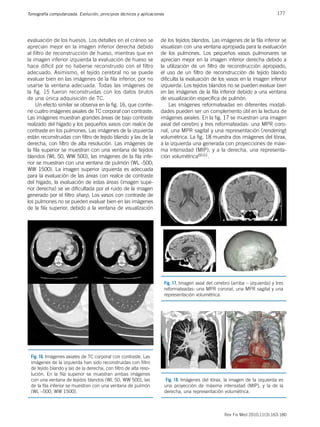 177
Tomografía computarizada. Evolución, principios técnicos y aplicaciones
Rev Fis Med 2010;11(3):163-180
evaluación de los huesos. Los detalles en el cráneo se
aprecian mejor en la imagen inferior derecha debido
al filtro de reconstrucción de hueso, mientras que en
la imagen inferior izquierda la evaluación de hueso se
hace difícil por no haberse reconstruido con el filtro
adecuado. Asimismo, el tejido cerebral no se puede
evaluar bien en las imágenes de la fila inferior, por no
usarse la ventana adecuada. Todas las imágenes de
la fig. 15 fueron reconstruidas con los datos brutos
de una única adquisición de TC.
Un efecto similar se observa en la fig. 16, que contie-
ne cuatro imágenes axiales de TC corporal con contraste.
Las imágenes muestran grandes áreas de bajo contraste
realzado del hígado y los pequeños vasos con realce de
contraste en los pulmones. Las imágenes de la izquierda
están reconstruidas con filtro de tejido blando y las de la
derecha, con filtro de alta resolución. Las imágenes de
la fila superior se muestran con una ventana de tejidos
blandos (WL 50, WW 500), las imágenes de la fila infe-
rior se muestran con una ventana de pulmón (WL -500;
WW 1500). La imagen superior izquierda es adecuada
para la evaluación de las áreas con realce de contraste
del hígado, la evaluación de estas áreas (imagen supe-
rior derecha) se ve dificultada por el ruido de la imagen
generado por el filtro sharp. Los vasos con contraste de
los pulmones no se pueden evaluar bien en las imágenes
de la fila superior, debido a la ventana de visualización
de los tejidos blandos. Las imágenes de la fila inferior se
visualizan con una ventana apropiada para la evaluación
de los pulmones. Los pequeños vasos pulmonares se
aprecian mejor en la imagen inferior derecha debido a
la utilización de un filtro de reconstrucción apropiado,
el uso de un filtro de reconstrucción de tejido blando
dificulta la evaluación de los vasos en la imagen inferior
izquierda. Los tejidos blandos no se pueden evaluar bien
en las imágenes de la fila inferior debido a una ventana
de visualización específica de pulmón.
Las imágenes reformateadas en diferentes modali-
dades pueden ser un complemento útil en la lectura de
imágenes axiales. En la fig. 17 se muestran una imagen
axial del cerebro y tres reformateadas: una MPR coro-
nal, una MPR sagital y una representación (rendering)
volumétrica. La fig. 18 muestra dos imágenes del tórax,
a la izquierda una generada con proyecciones de máxi-
ma intensidad (MIP), y a la derecha, una representa-
ción volumétrica60,61.
Fig. 16. Imágenes axiales de TC corporal con contraste. Las
imágenes de la izquierda han sido reconstruidas con filtro
de tejido blando y las de la derecha, con filtro de alta reso-
lución. En la fila superior se muestran ambas imágenes
con una ventana de tejidos blandos (WL 50, WW 500), las
de la fila inferior se muestran con una ventana de pulmón
(WL –500, WW 1500).
Fig. 17. Imagen axial del cerebro (arriba – izquierda) y tres
reformateadas: una MPR coronal, una MPR sagital y una
representación volumétrica.
Fig. 18. Imágenes del tórax, la imagen de la izquierda es
una proyección de máxima intensidad (MIP), y la de la
derecha, una representación volumétrica.
 