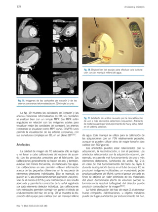 178 A Calzado y J Geleijns
Rev Fis Med 2010;11(3):163-180
La fig. 19 muestra las cavidades del corazón y las
arterias coronarias reformateadas en 2D; las cavidades
se evalúan bien con un simple MPR (los MPR están
angulados en relación con las imágenes axiales para
visualizar mejor las cavidades del corazón), las arterias
coronarias se visualizan como MPR curvo. El MPR curvo
permite la visualización de las arterias coronarias, con
sus curvaturas complejas en 3D, en un plano 2D62,63.
Artefactos
La calidad de imagen de TC adecuada sólo se logra
si se llevan a cabo calibraciones del escáner de acuer-
do con los protocolos prescritos por el fabricante. Las
calibraciones generalmente se hacen en aire, y también,
aunque con menos frecuencia, en maniquíes con agua.
Las calibraciones en aire permiten obtener información
acerca de las pequeñas diferencias en la respuesta de
elementos detectores individuales. Esto es esencial, ya
que en la TC las proyecciones tienen que tener una preci-
sión de al menos el 0,5% y una calibración en aire resulta
adecuada y permite la corrección de la señal registrada
por cada elemento detector individual. Las calibraciones
con maniquíes permiten corregir (en parte) el efecto de
endurecimiento del haz; en la fig. 20 se muestra la dis-
posición del equipo para calibrar con un maniquí relleno
de agua. Este maniquí se utiliza para la calibración de
las adquisiciones con un FOV relativamente pequeño,
aunque se pueden utilizar otros de mayor tamaño para
calibrar con FOV grande.
Los artefactos pueden estar relacionados con la
adquisición, la reconstrucción, o con el paciente. Los
artefactos relacionados con la adquisición ocurren, por
ejemplo, en caso de mal funcionamiento de uno o más
elementos detectores, (artefactos de anillo, fig. 21);
en caso de mal funcionamiento del tubo de rayos X
durante la adquisición (arcos en el tubo de rayos X ) se
producen imágenes inutilizables; un muestreado pobre
produce patrones de Moiré; como el grosor de corte es
finito se obtiene un valor promedio de los materiales
del vóxel, denominado efecto de volumen parcial; la
luminiscencia residual (afterglow) del detector puede
producir borrosidad en la imagen63,64.
La fuerte atenuación del haz de rayos X al atravesar
hueso compacto, calcificaciones, u objetos metálicos
puede dar lugar a artefactos por endurecimiento del haz.
Fig. 21. Artefacto de anillos causado por la descalibración
de uno o más elementos detectores (izquierda). Artefacto
de metal causado por endurecimiento del haz y señal débil
en el sistema detector.
Fig. 19. Imágenes de las cavidades del corazón y de las
arterias coronarias reformateadas en 2D simple y curvo.
Fig. 20. Disposición del equipo para efectuar una calibra-
ción con un maniquí relleno de agua.
 