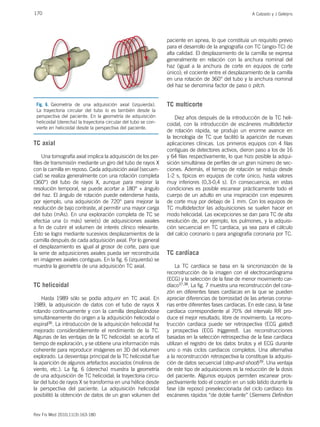 170 A Calzado y J Geleijns
Rev Fis Med 2010;11(3):163-180
TC axial
Una tomografía axial implica la adquisición de los per-
files de transmisión mediante un giro del tubo de rayos X
con la camilla en reposo. Cada adquisición axial (secuen-
cial) se realiza generalmente con una rotación completa
(360°) del tubo de rayos X, aunque para mejorar la
resolución temporal, se puede acortar a 180° + ángulo
del haz. El ángulo de rotación puede extenderse hasta,
por ejemplo, una adquisición de 720° para mejorar la
resolución de bajo contraste, al permitir una mayor carga
del tubo (mAs). En una exploración completa de TC se
efectúa una (o más) serie(s) de adquisiciones axiales
a fin de cubrir el volumen de interés clínico relevante.
Esto se logra mediante sucesivos desplazamientos de la
camilla después de cada adquisición axial. Por lo general
el desplazamiento es igual al grosor de corte, para que
la serie de adquisiciones axiales pueda ser reconstruida
en imágenes axiales contiguas. En la fig. 6 (izquierda) se
muestra la geometría de una adquisición TC axial.
TC helicoidal
Hasta 1989 sólo se podía adquirir en TC axial. En
1989, la adquisición de datos con el tubo de rayos X
rotando continuamente y con la camilla desplazándose
simultáneamente dio origen a la adquisición helicoidal o
espiral36. La introducción de la adquisición helicoidal ha
mejorado considerablemente el rendimiento de la TC.
Algunas de las ventajas de la TC helicoidal: se acorta el
tiempo de exploración, y se obtiene una información más
coherente para reproducir imágenes en 3D del volumen
explorado. La desventaja principal de la TC helicoidal fue
la aparición de algunos artefactos asociados (molinos de
viento, etc.). La fig. 6 (derecha) muestra la geometría
de una adquisición de TC helicoidal; la trayectoria circu-
lar del tubo de rayos X se transforma en una hélice desde
la perspectiva del paciente. La adquisición helicoidal
posibilitó la obtención de datos de un gran volumen del
paciente en apnea, lo que constituía un requisito previo
para el desarrollo de la angiografía con TC (angio-TC) de
alta calidad. El desplazamiento de la camilla se expresa
generalmente en relación con la anchura nominal del
haz (igual a la anchura de corte en equipos de corte
único); el cociente entre el desplazamiento de la camilla
en una rotación de 360° del tubo y la anchura nominal
del haz se denomina factor de paso o pitch.
TC multicorte
Diez años después de la introducción de la TC heli-
coidal, con la introducción de escáneres multidetector
de rotación rápida, se produjo un enorme avance en
la tecnología de TC que facilitó la aparición de nuevas
aplicaciones clínicas. Los primeros equipos con 4 filas
contiguas de detectores activos, dieron paso a los de 16
y 64 filas respectivamente, lo que hizo posible la adqui-
sición simultánea de perfiles de un gran número de sec-
ciones. Además, el tiempo de rotación se redujo desde
1-2 s, típicos en equipos de corte único, hasta valores
muy inferiores (0,3-0,4 s). En consecuencia, en estas
condiciones es posible escanear prácticamente todo el
cuerpo de un adulto en una inspiración con espesores
de corte muy por debajo de 1 mm. Con los equipos de
TC multidetector las adquisiciones se suelen hacer en
modo helicoidal. Las excepciones se dan para TC de alta
resolución de, por ejemplo, los pulmones, y la adquisi-
ción secuencial en TC cardíaca, ya sea para el cálculo
del calcio coronario o para angiografía coronaria por TC.
TC cardíaca
La TC cardíaca se basa en la sincronización de la
reconstrucción de la imagen con el electrocardiograma
(ECG) y la selección de la fase de menor movimiento car-
díaco37,38. La fig. 7 muestra una reconstrucción del cora-
zón en diferentes fases cardíacas en la que se pueden
apreciar diferencias de borrosidad de las arterias corona-
rias entre diferentes fases cardíacas. En este caso, la fase
cardíaca correspondiente al 70% del intervalo RR pro-
duce el mejor resultado, libre de movimiento. La recons-
trucción cardíaca puede ser retrospectiva (ECG gated)
y prospectiva (ECG triggered). Las reconstrucciones
basadas en la selección retrospectiva de la fase cardíaca
utilizan el registro de los datos brutos y el ECG durante
uno o más ciclos cardíacos completos. Una alternativa
a la reconstrucción retrospectiva la constituye la adquisi-
ción de datos secuencial (step-and-shoot)39. Una ventaja
de este tipo de adquisiciones es la reducción de la dosis
del paciente. Algunos equipos permiten escanear pros-
pectivamente todo el corazón en un solo latido durante la
fase (de reposo) preseleccionada del ciclo cardíaco: los
escáneres rápidos “de doble fuente” (Siemens Definition
Fig. 6. Geometría de una adquisición axial (izquierda).
La trayectoria circular del tubo lo es también desde la
perspectiva del paciente. En la geometría de adquisición
helicoidal (derecha) la trayectoria circular del tubo se con-
vierte en helicoidal desde la perspectiva del paciente.
 