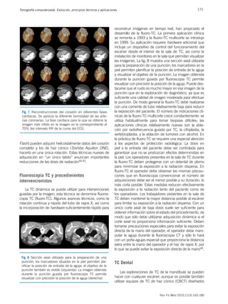 171
Tomografía computarizada. Evolución, principios técnicos y aplicaciones
Rev Fis Med 2010;11(3):163-180
Flash) pueden adquirir helicoidalmente datos del corazón
completo y los de haz cónico (Toshiba Aquilion ONE),
hacerlo en una única rotación. Estas técnicas nuevas de
adquisición en “un único latido” anuncian importantes
reducciones de las dosis de radiación40-43.
Fluoroscopia TC y procedimientos
intervencionistas
La TC dinámica se puede utilizar para intervenciones
guiadas por la imagen; esta técnica se denomina fluoros-
copia TC (fluoro-TC). Algunos avances técnicos, como la
rotación continua y rápida del tubo de rayos X, así como
la incorporación de hardware suficientemente rápido para
reconstruir imágenes en tiempo real, han propiciado el
desarrollo de la fluoro-TC. La primera aplicación clínica
se remonta a 1993 y la fluoro-TC multicorte se introdujo
en 1999. Su aplicación requiere hardware adicional que
incluye un dispositivo de control del funcionamiento del
escáner desde el interior de la sala de TC, así como la
instalación de monitores en la sala que permitan visualizar
las imágenes. La fig. 8 muestra una sección axial utilizada
para la preparación de una punción; los marcadores en la
piel permiten planificar la posición de entrada de la aguja
y visualizar el objetivo de la punción. La imagen obtenida
durante la punción guiada por fluoroscopia TC permite
visualizar con precisión la posición de la aguja. Puede des-
tacarse que el ruido es mucho mayor en esa imagen de la
punción que en la exploración de diagnóstico, ya que es
suficiente una calidad de imagen moderada para efectuar
la punción. De modo general la fluoro-TC debe realizarse
con una corriente de tubo relativamente baja para reducir
la exposición del paciente. El número de indicaciones clí-
nicas de la fluoro-TC multicorte crece constantemente: se
utiliza habitualmente para tomar biopsias difíciles; las
aplicaciones clínicas relativamente nuevas son la abla-
ción por radiofrecuencia guiada por TC, la cifoplastia, la
vertebroplastia, y la ablación de tumores con alcohol. En
la práctica de fluoro-TC se requiere una especial atención
a los aspectos de protección radiológica. La dosis en
piel a la entrada del paciente debe ser controlada para
garantizar que no se produzcan efectos deterministas en
la piel. Los operadores presentes en la sala de TC durante
la fluoro-TC deben protegerse con un delantal de plomo
para minimizar la exposición a la radiación dispersa. En
fluoro-TC el operador debe observar las mismas precau-
ciones que en fluoroscopia convencional: el número de
adquisiciones debe ser el menor posible y su duración, lo
más corta posible. Estas medidas reducen efectivamente
la exposición a la radiación tanto del paciente como de
los operadores. Los trabajadores presentes en la sala de
TC deben mantener la mayor distancia posible al escáner
para limitar su exposición a la radiación dispersa. Con un
único corte axial de baja dosis suele ser suficiente para
obtener información sobre el estado del procedimiento, de
modo que sólo debe utilizarse adquisición dinámica si el
corte axial no proporciona información suficiente. Deben
tomarse precauciones especiales para evitar la exposición
directa de la mano del operador, el operador debe mani-
pular la aguja durante la fluoroscopia CT y sólo lo hará
con un porta-agujas especial que proporciona la distancia
extra entre la mano del operador y el haz de rayos X, por
lo que se puede evitar la exposición directa de la mano44.
TC Dental
Las exploraciones de TC de la mandíbula se pueden
hacer con cualquier escáner, aunque es posible también
utilizar equipos de TC de haz cónico (CBCT) diseñados
0% 10%
50% 60% 70% 80% 90%
20% 30% 40%
Fig. 7. Reconstrucciones del corazón en diferentes fases
cardíacas. Se aprecia la diferente borrosidad de las arte-
rias coronarias. La fase cardíaca para la que se obtiene la
imagen más nítida en la imagen es la correspondiente al
70% del intervalo RR de la curva del ECG.
Fig. 8. Sección axial utilizada para la preparación de una
punción; los marcadores situados en la piel permiten pla-
nificar la posición de entrada de la aguja; el objetivo de la
punción también es visible (izquierda). La imagen obtenida
durante la punción guiada por fluoroscopia TC permite
visualizar con precisión la posición de la aguja (derecha).
 