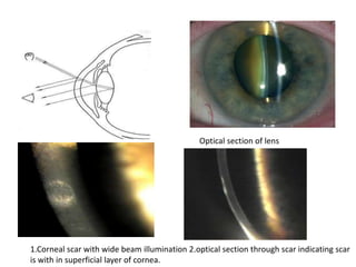 Optical section of lens
1.Corneal scar with wide beam illumination 2.optical section through scar indicating scar
is with in superficial layer of cornea.
 