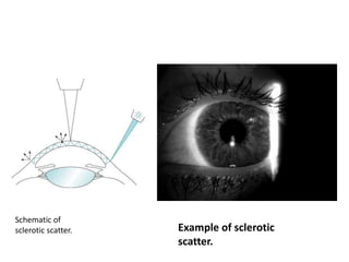 Schematic of
sclerotic scatter. Example of sclerotic
scatter.
 