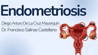 Endometriosis
DiegoArturoDeLaCruzMayorquin
Dr.FranciscoSalinasCastellano
 