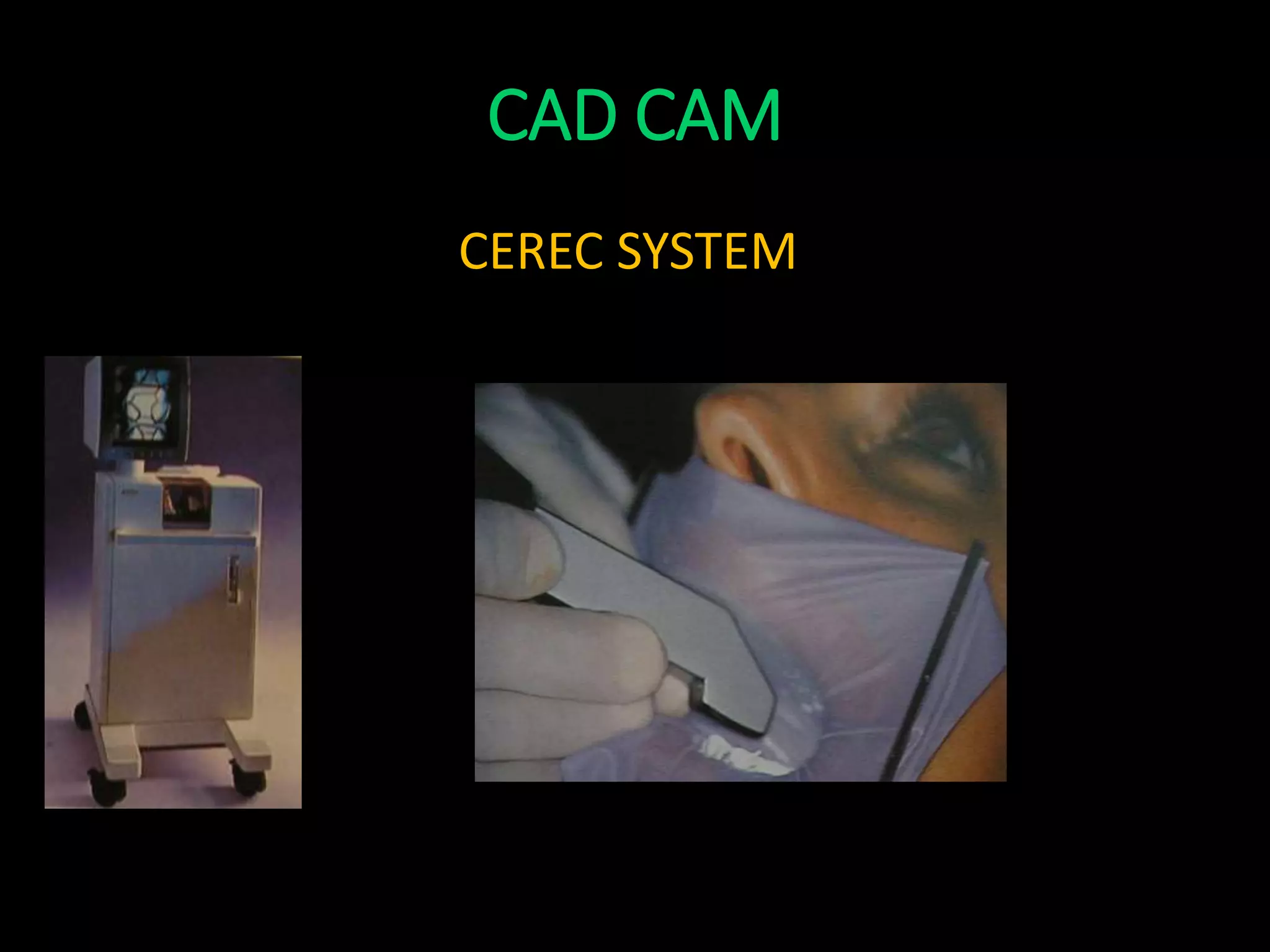 CAD CAM
CEREC SYSTEM
 