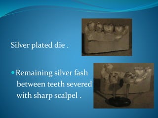 Silver plated die .
Remaining silver fash
between teeth severed
with sharp scalpel .
 