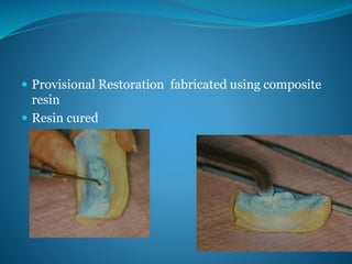  Provisional Restoration fabricated using composite
resin
 Resin cured
 