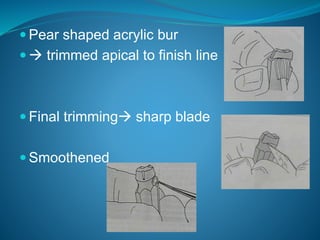  Pear shaped acrylic bur
  trimmed apical to finish line
 Final trimming sharp blade
 Smoothened
 