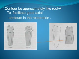 Contour be approximately like root
To facilitate good axial
contours in the restoration .
 