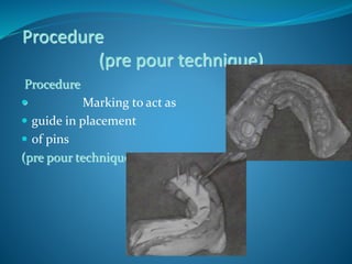 Procedure
(pre pour technique)
Procedure
 Marking to act as
 guide in placement
 of pins
(pre pour technique)
 