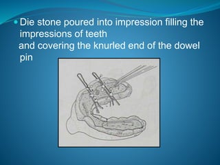  Die stone poured into impression filling the
impressions of teeth
and covering the knurled end of the dowel
pin
 