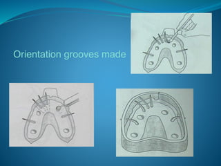 Orientation grooves made
 