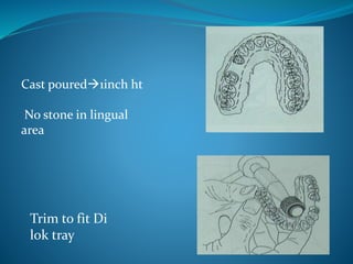 Cast poured1inch ht
No stone in lingual
area
Trim to fit Di
lok tray
 
