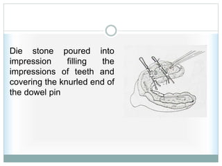 Die stone poured into
impression filling the
impressions of teeth and
covering the knurled end of
the dowel pin
 