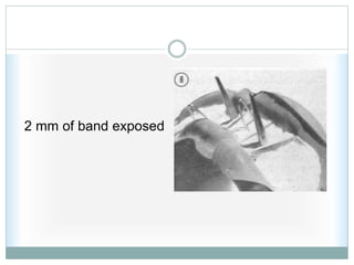 2 mm of band exposed
 