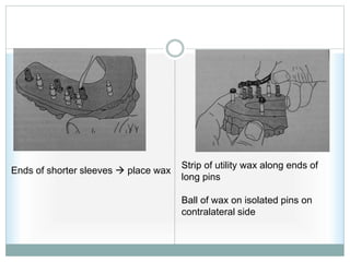 Strip of utility wax along ends of
long pins
Ball of wax on isolated pins on
contralateral side
Ends of shorter sleeves  place wax
 