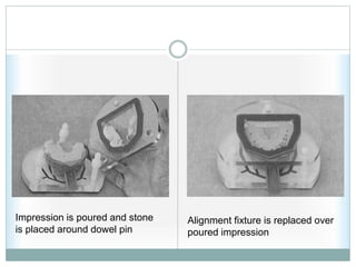 Impression is poured and stone
is placed around dowel pin
Alignment fixture is replaced over
poured impression
 
