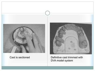 Cast is sectioned Definitive cast trimmed with
DVA model system
 