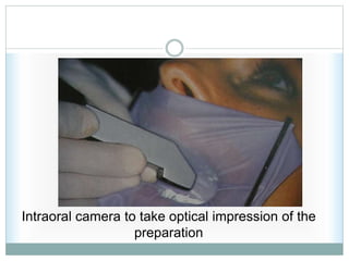 Intraoral camera to take optical impression of the
preparation
 