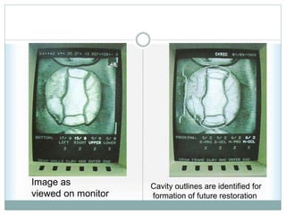Image as
viewed on monitor
Cavity outlines are identified for
formation of future restoration
 