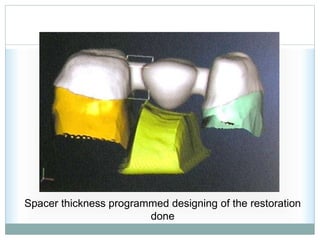 Spacer thickness programmed designing of the restoration
done
 