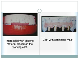 Impression with silicone
material placed on the
working cast
Cast with soft tissue mask
 