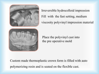 Irreversible hydrocolloid impression
Fill with the fast setting, medium
viscosity polyvinyl impression material
Place the polyvinyl cast into
the pre operative mold
Custom made thermoplastic crown form is filled with auto
polymerizing resin and is seated on the flexible cast.
 