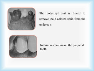 The polyvinyl cast is flexed to
remove tooth colored resin from the
undercuts.
Interim restoration on the prepared
tooth
 
