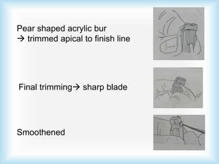 Pear shaped acrylic bur
 trimmed apical to finish line
Final trimming sharp blade
Smoothened
 